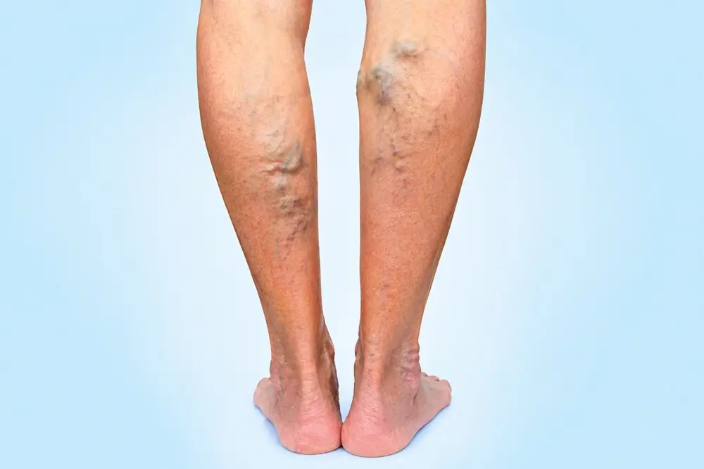 Chronic Venous Insufficiency & Varicose Veins Treatment